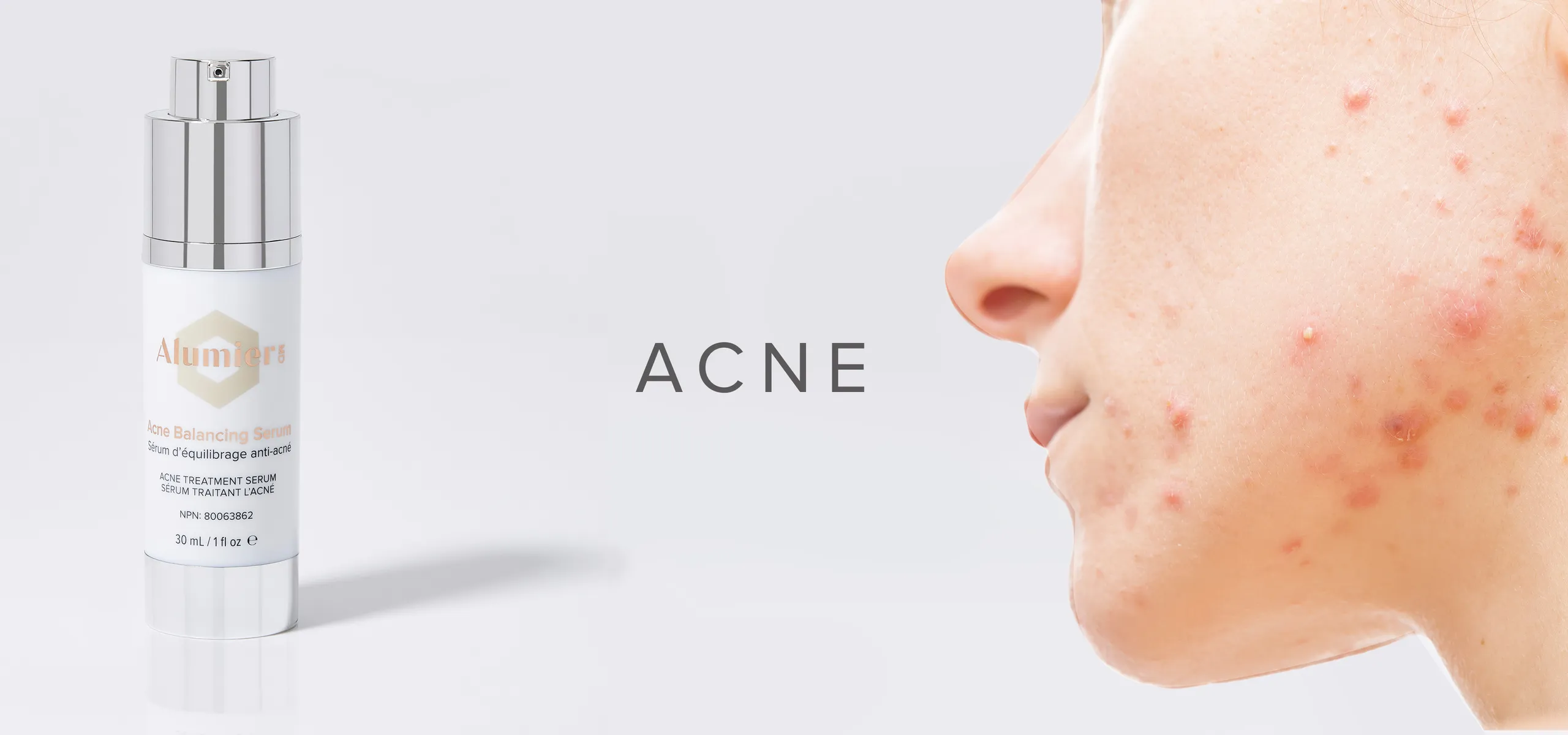 acne-skin-care