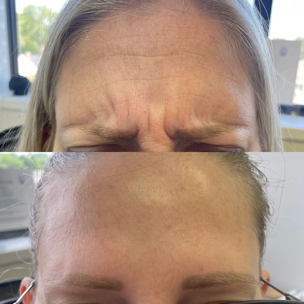 Belleville botox injection before and after