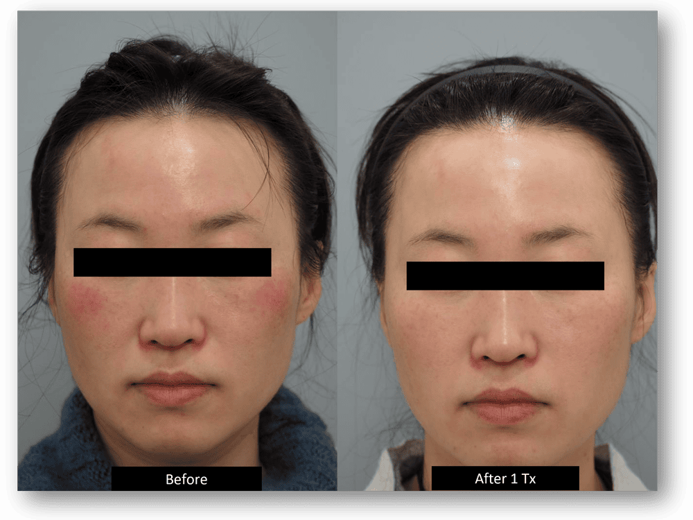Before and after photo of a DermaV laser treatment in Belleville, demonstrating a significant reduction in facial redness and broken capillaries.