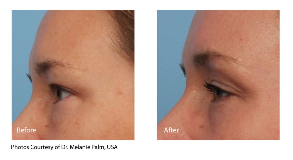 Patient before and after an eCO2 laser treatment for acne scarring in Belleville. The after image shows significantly smoother skin.