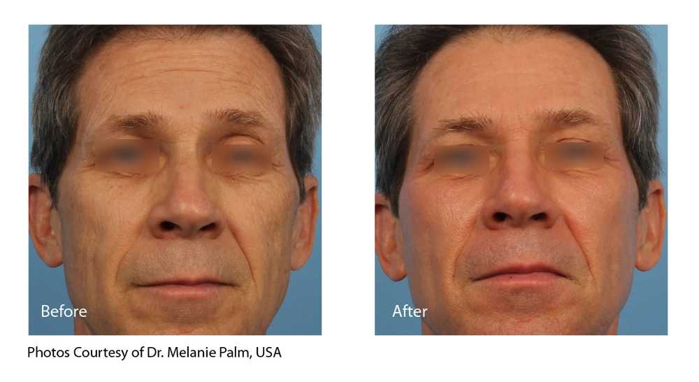 Before and after results of an eCO2 laser treatment in Belleville showing reduced fine lines and improved skin texture.