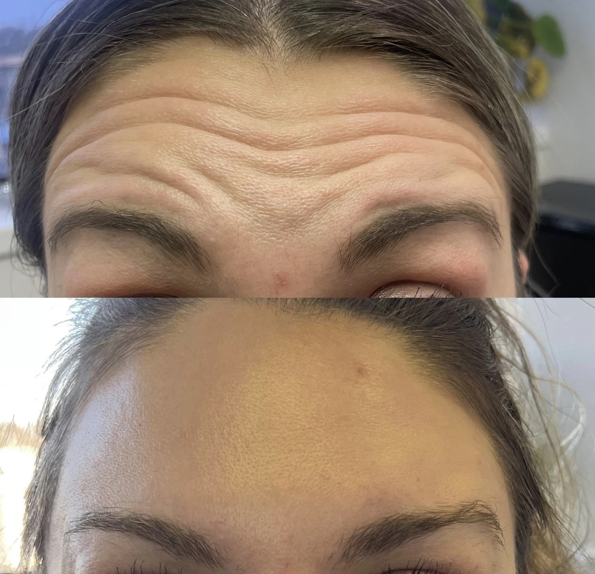 Botox Injections In Belleville Before & After