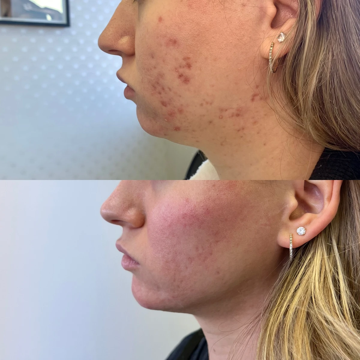 Before & after a deoxycholic acid treatment in Belleville