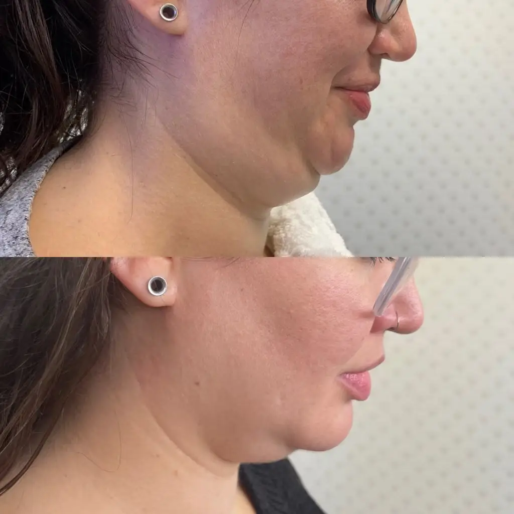 Results before and after deoxycholic acid injections