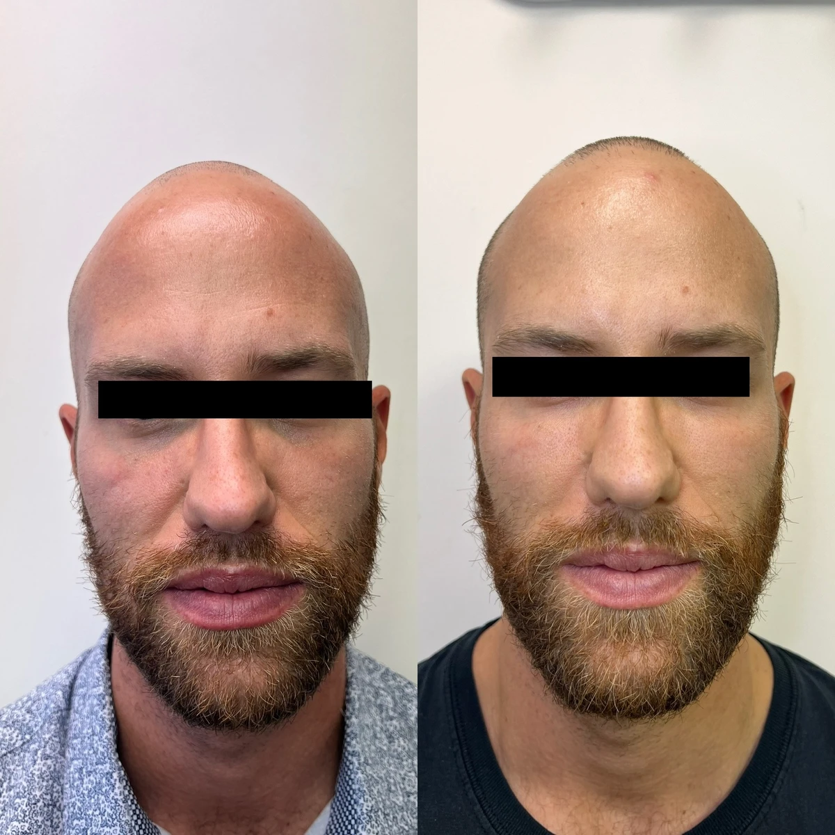 Filler injection procedure before and after