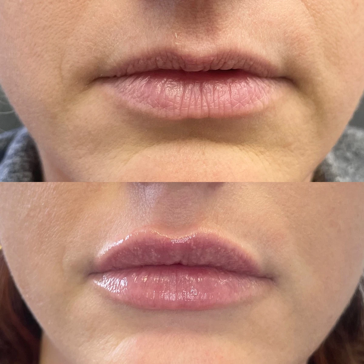 Lip filler injection performed in Belleville