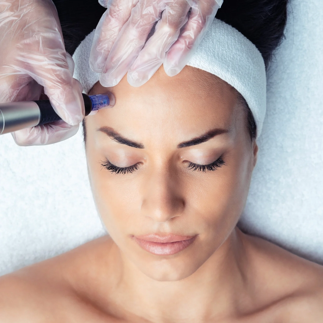 Microneedling treatment in Belleville for smoother, firmer skin
