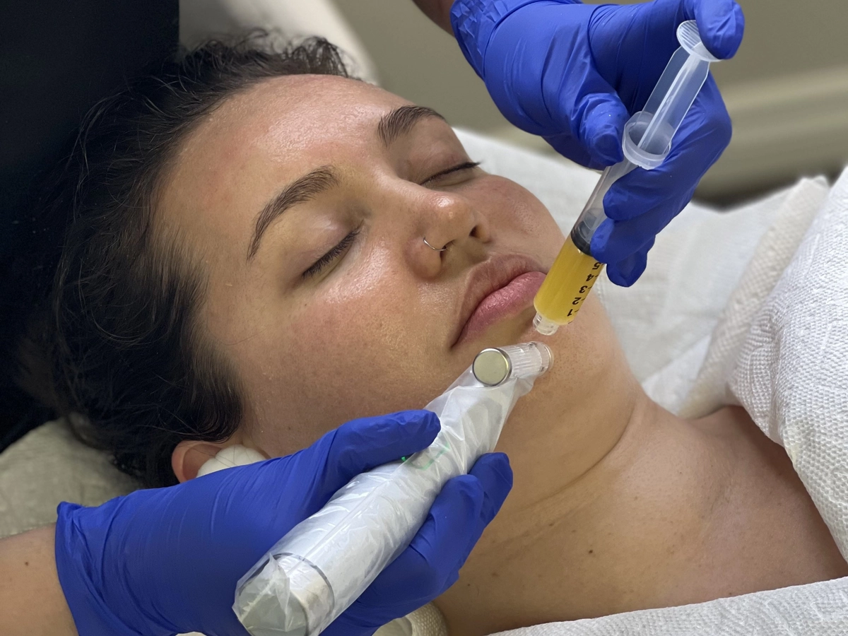 PRP microneedling session using MicroPen EVO in Belleville