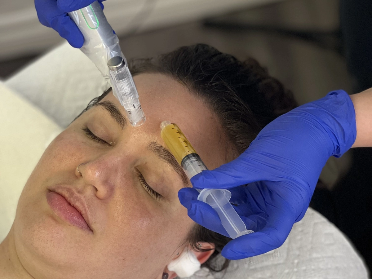 Collagen induction therapy for acne scars and fine lines