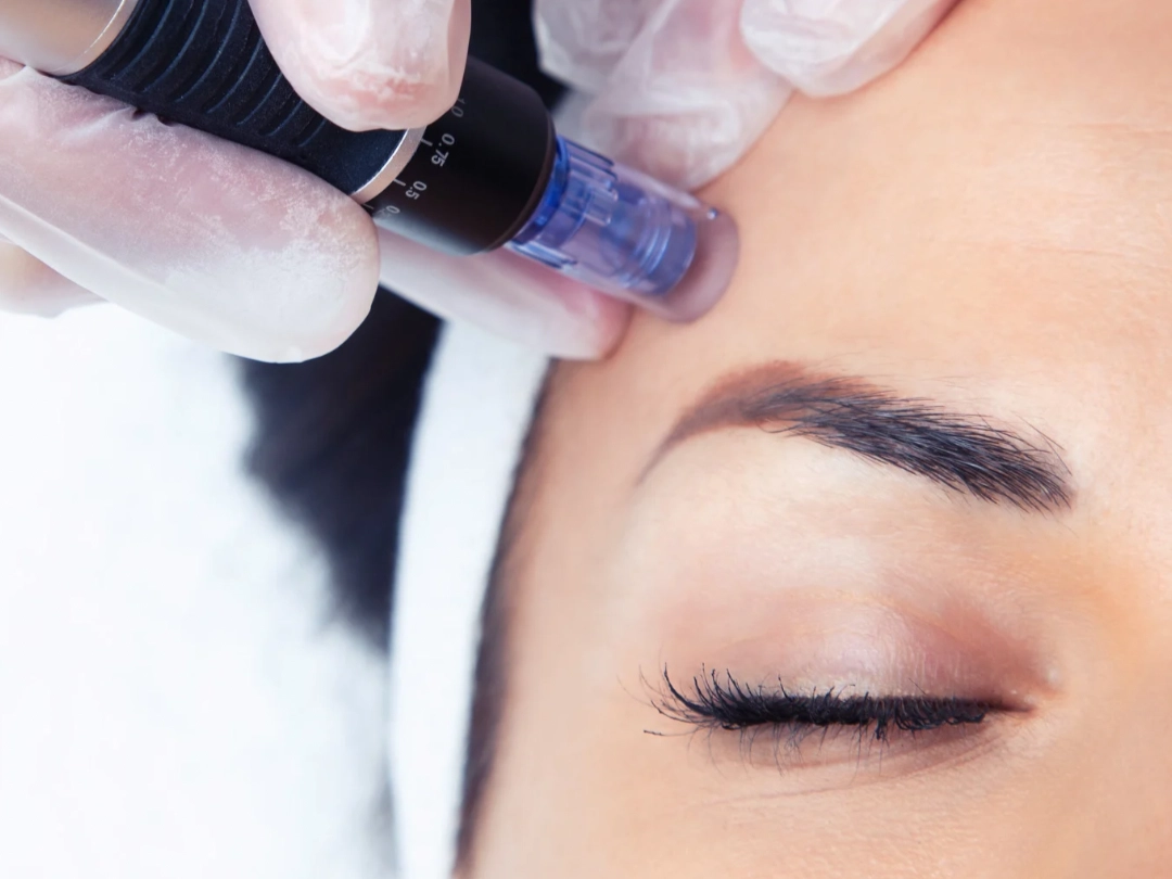 Close-up of PRP application during microneedling session