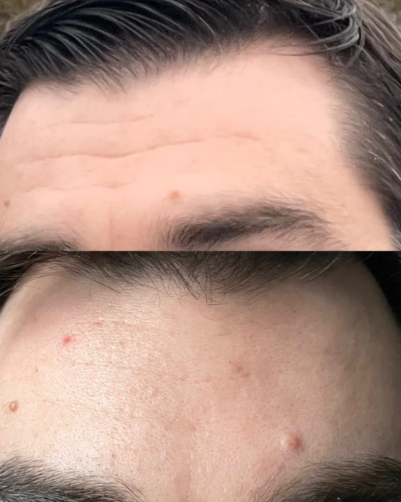 Before and after neurotoxin injection results showing forehead wrinkle reduction - top image displays horizontal forehead lines before treatment, bottom image shows smooth forehead skin after Botox treatment in Belleville