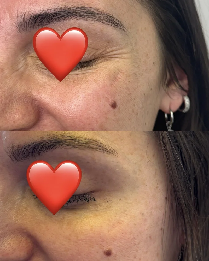 Before and after crow's feet neurotoxin treatment results - top image shows fine lines around eye area before injection, bottom image displays smoother skin around eyes after Botox treatment in Belleville