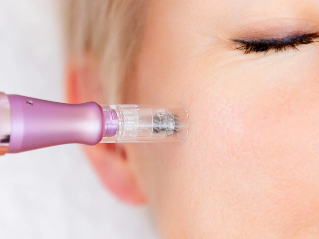 Microneedling with PRP for collagen boosting in Belleville