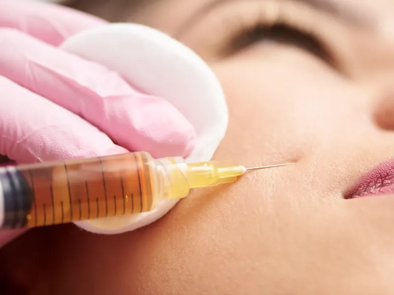 Detailed view of PRP skin treatment injection targeting facial rejuvenation and wrinkle reduction